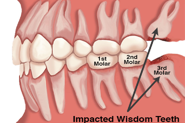 Post-Extraction Care
